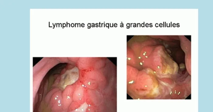 cancer-de-lestomac-comment-eviter-la-maladie