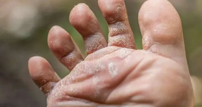 allo-dr-pied-dathlete-comment-prevenir-et-guerir-dun-mal-genant