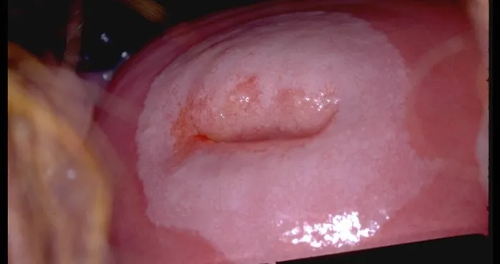 dossier-sante-cancer-du-col-de-luterus-la-mort-au-bout-du-sexe